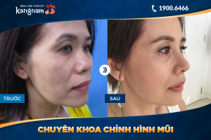 Hình ảnh nâng mũi trước sau thẩm mỹ Kangnam - Ca 19