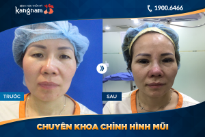 Hình ảnh nâng mũi trước sau thẩm mỹ Kangnam - Ca 20