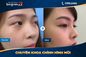 Hình ảnh nâng mũi trước sau thẩm mỹ Kangnam - Ca 21