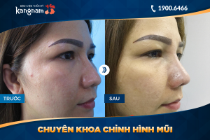 Hình ảnh nâng mũi trước sau thẩm mỹ Kangnam - Ca 22