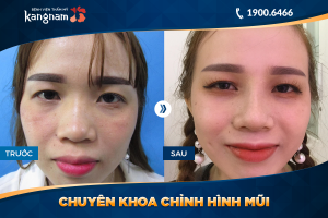 Hình ảnh nâng mũi trước sau thẩm mỹ Kangnam - Ca 23