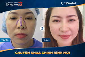 Hình ảnh nâng mũi trước sau thẩm mỹ Kangnam - Ca 24