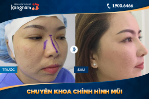 Hình ảnh nâng mũi trước sau thẩm mỹ Kangnam - Ca 24