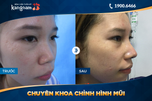 Hình ảnh nâng mũi trước sau thẩm mỹ Kangnam - Ca 25