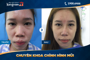 Hình ảnh nâng mũi trước sau thẩm mỹ Kangnam - Ca 25