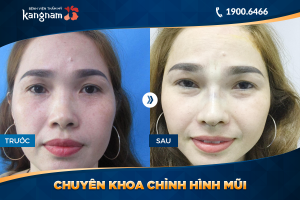 Hình ảnh nâng mũi trước sau thẩm mỹ Kangnam - Ca 26