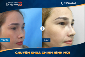 Hình ảnh nâng mũi trước sau thẩm mỹ Kangnam - Ca 26