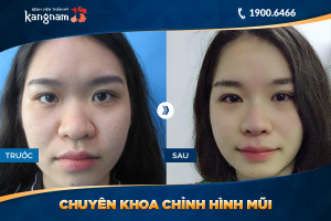 Hình ảnh nâng mũi trước sau thẩm mỹ Kangnam - Ca 27