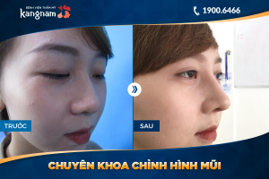 Hình ảnh nâng mũi trước sau thẩm mỹ Kangnam - Ca 28