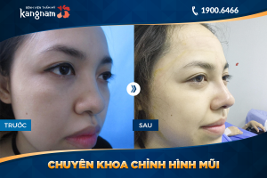 Hình ảnh nâng mũi trước sau thẩm mỹ Kangnam - Ca 29