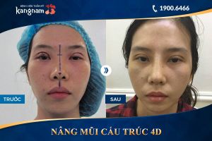Hình ảnh nâng mũi trước sau thẩm mỹ Kangnam - Ca 1