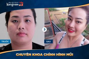 Hình ảnh nâng mũi trước sau thẩm mỹ Kangnam - Ca 2
