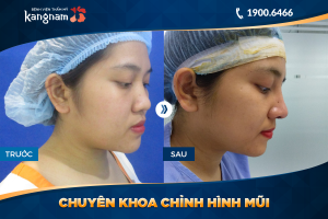 Hình ảnh nâng mũi trước sau thẩm mỹ Kangnam - Ca 31