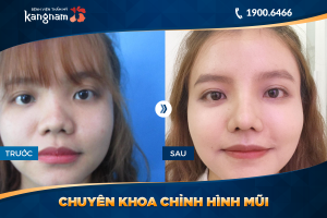 Hình ảnh nâng mũi trước sau thẩm mỹ Kangnam - Ca 32