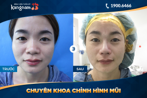 Hình ảnh nâng mũi trước sau thẩm mỹ Kangnam - Ca 33