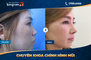 Hình ảnh nâng mũi trước sau thẩm mỹ Kangnam - Ca 34