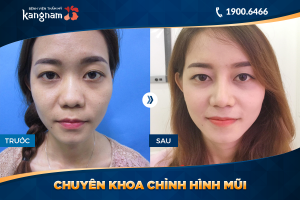 Hình ảnh nâng mũi trước sau thẩm mỹ Kangnam - Ca 35