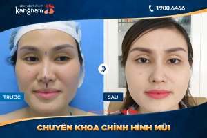 Hình ảnh nâng mũi trước sau thẩm mỹ Kangnam - Ca 36