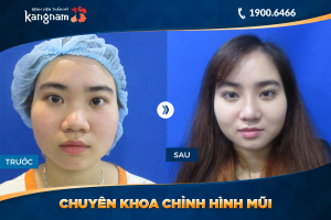 Hình ảnh nâng mũi trước sau thẩm mỹ Kangnam - Ca 37