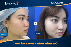 Hình ảnh nâng mũi trước sau thẩm mỹ Kangnam - Ca 37