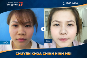 Hình ảnh nâng mũi trước sau thẩm mỹ Kangnam - Ca 38
