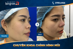 Hình ảnh nâng mũi trước sau thẩm mỹ Kangnam - Ca 39