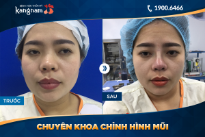 Hình ảnh nâng mũi trước sau thẩm mỹ Kangnam - Ca 39