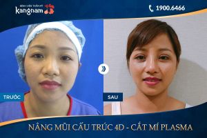 Hình ảnh nâng mũi trước sau thẩm mỹ Kangnam - Ca 3