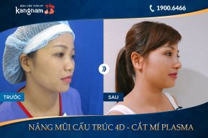 Hình ảnh nâng mũi trước sau thẩm mỹ Kangnam - Ca 3