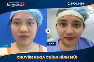 Hình ảnh nâng mũi trước sau thẩm mỹ Kangnam - Ca 40