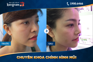 Hình ảnh nâng mũi trước sau thẩm mỹ Kangnam - Ca 41