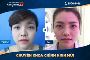 Hình ảnh nâng mũi trước sau thẩm mỹ Kangnam - Ca 41