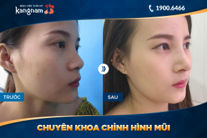 Hình ảnh nâng mũi trước sau thẩm mỹ Kangnam - Ca 42