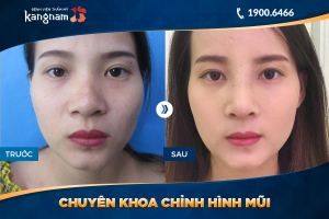 Hình ảnh nâng mũi trước sau thẩm mỹ Kangnam - Ca 42