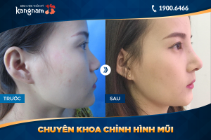 Hình ảnh nâng mũi trước sau thẩm mỹ Kangnam - Ca 42