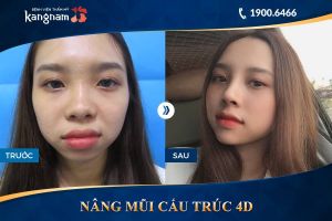 Hình ảnh nâng mũi trước sau thẩm mỹ Kangnam - Ca 4