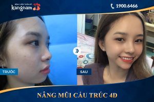 Hình ảnh nâng mũi trước sau thẩm mỹ Kangnam - Ca 4