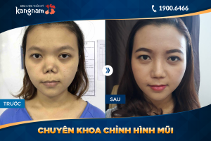 Hình ảnh nâng mũi trước sau thẩm mỹ Kangnam - Ca 6