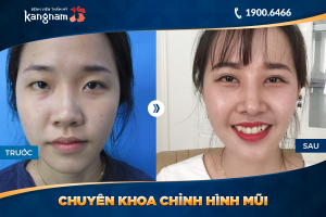 Hình ảnh nâng mũi trước sau thẩm mỹ Kangnam - Ca 7