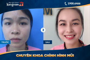 Hình ảnh nâng mũi trước sau thẩm mỹ Kangnam - Ca 8