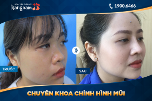 Hình ảnh nâng mũi trước sau thẩm mỹ Kangnam - Ca 9