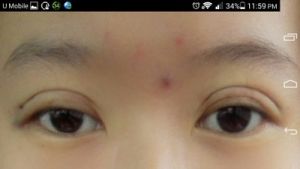 Mắt có nhiều nếp mí sau khi nhấn mí luồn chỉ