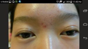 Mắt có nhiều nếp mí sau khi nhấn mí luồn chỉ