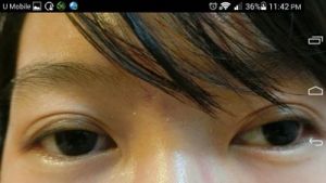 Mắt có nhiều nếp mí sau khi nhấn mí luồn chỉ