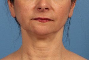 Nên phẫu thuật độn cằm và căng da cổ hay chỉ cần độn cằm thôi?