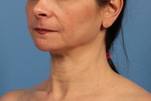 Nên phẫu thuật độn cằm và căng da cổ hay chỉ cần độn cằm thôi?