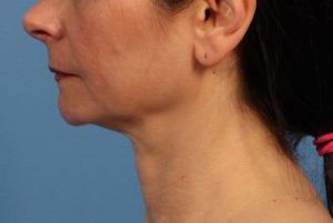 Nên phẫu thuật độn cằm và căng da cổ hay chỉ cần độn cằm thôi?