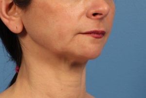 Nên phẫu thuật độn cằm và căng da cổ hay chỉ cần độn cằm thôi?