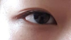 Nên chọn phương pháp tạo mắt hai mí nào?