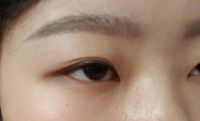Nên chọn phương pháp tạo mắt hai mí nào?